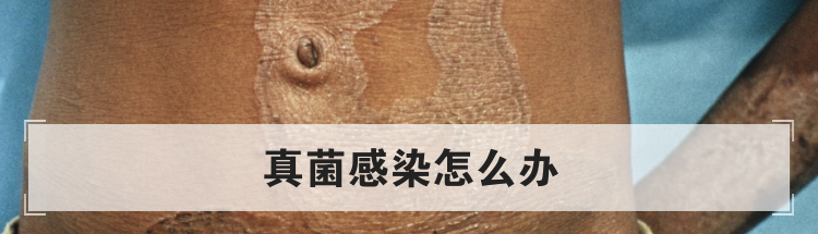 真菌感染怎么办