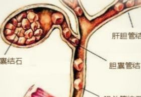 胆结石最佳治疗方法