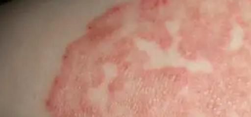 怎么做好皮炎的预防