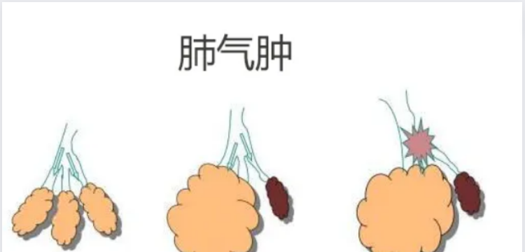 患有肺气肿的表现有哪些