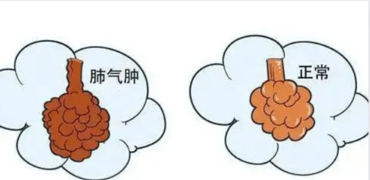 患有肺气肿的原因是什么