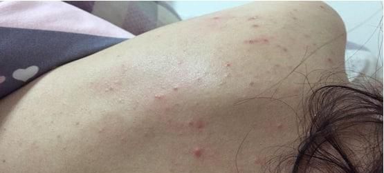 背部的痘痘怎么办