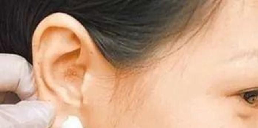 打耳洞后该如何预防感染