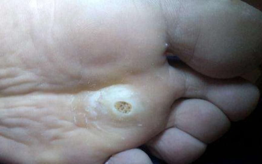 为什么脚上会长鸡眼