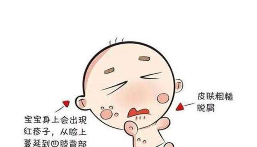 新生儿湿疹怎么办
