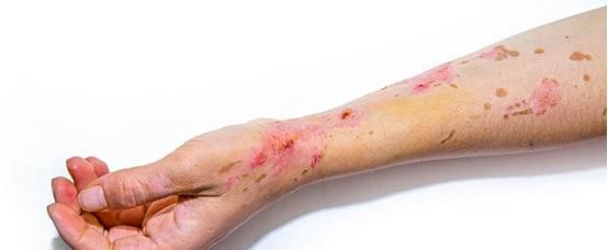 而牛奶,蚕豆菠萝等等也需要适当的少吃,毕竟这些对于过敏性紫癜患者