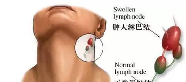 急性淋巴结炎怎样得的