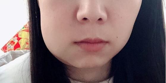 拔智齿会掉智商还能瘦脸
