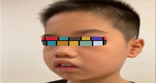 腺样体肥大不要紧吗为什么