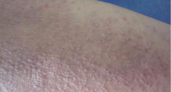 神经性皮炎是怎么回事