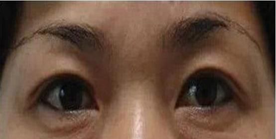 怎样消除脂肪型眼袋