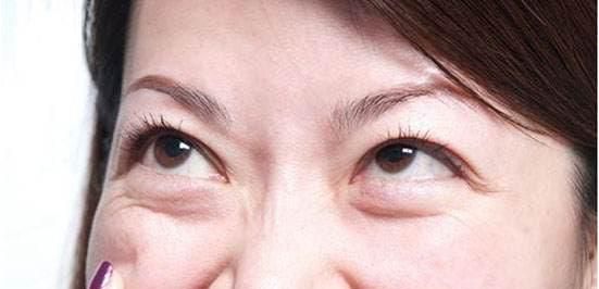 不熬夜为什么有眼袋