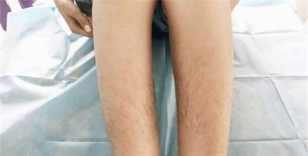 女性体毛过多的原因是什么？