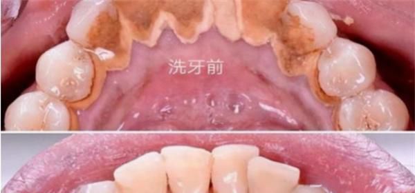洗牙齿好吗为什么
