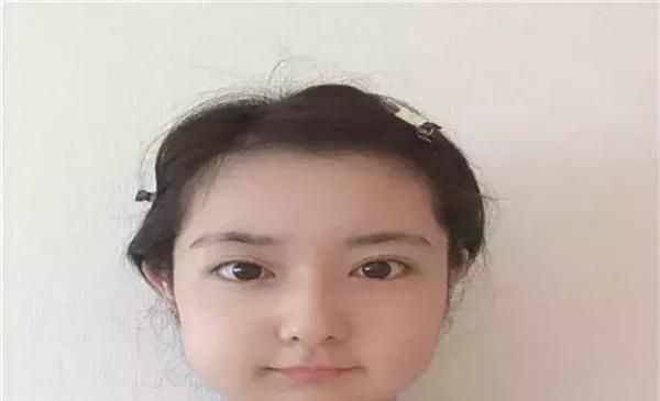 拔智齿脸肿了几天能好