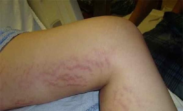 过度肥胖有哪些危害